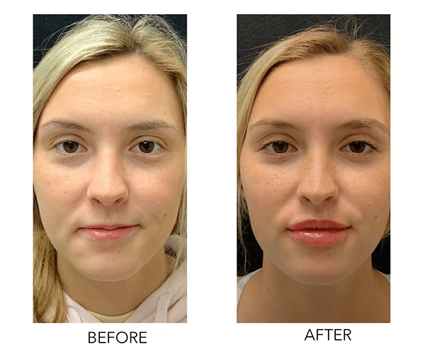 Complete Guide to Lip Fillers and Injections in Los Angeles