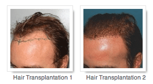 Why get a hair transplant?