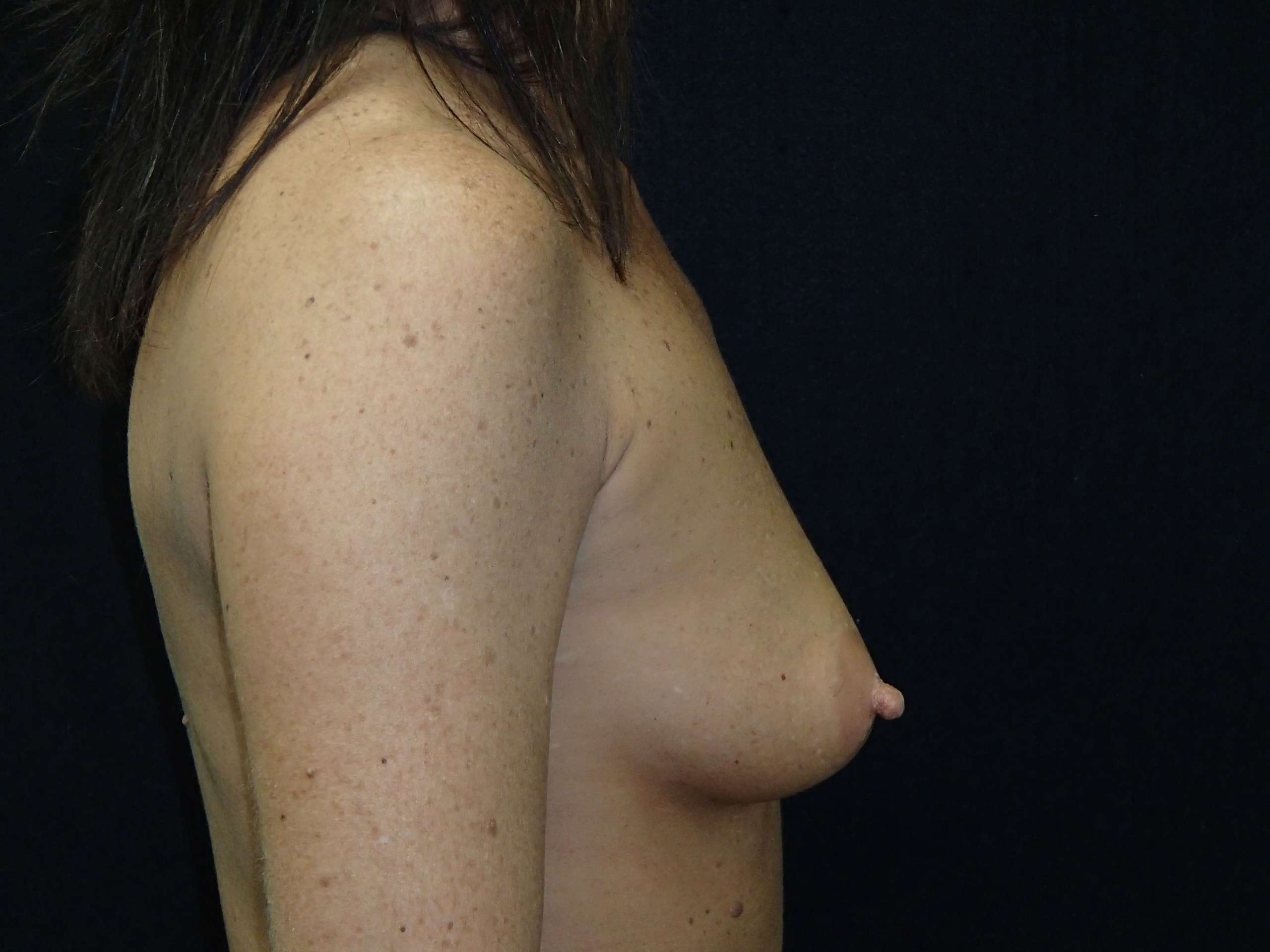 round breast augmentation before photo