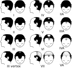 Norwood scale of hair loss