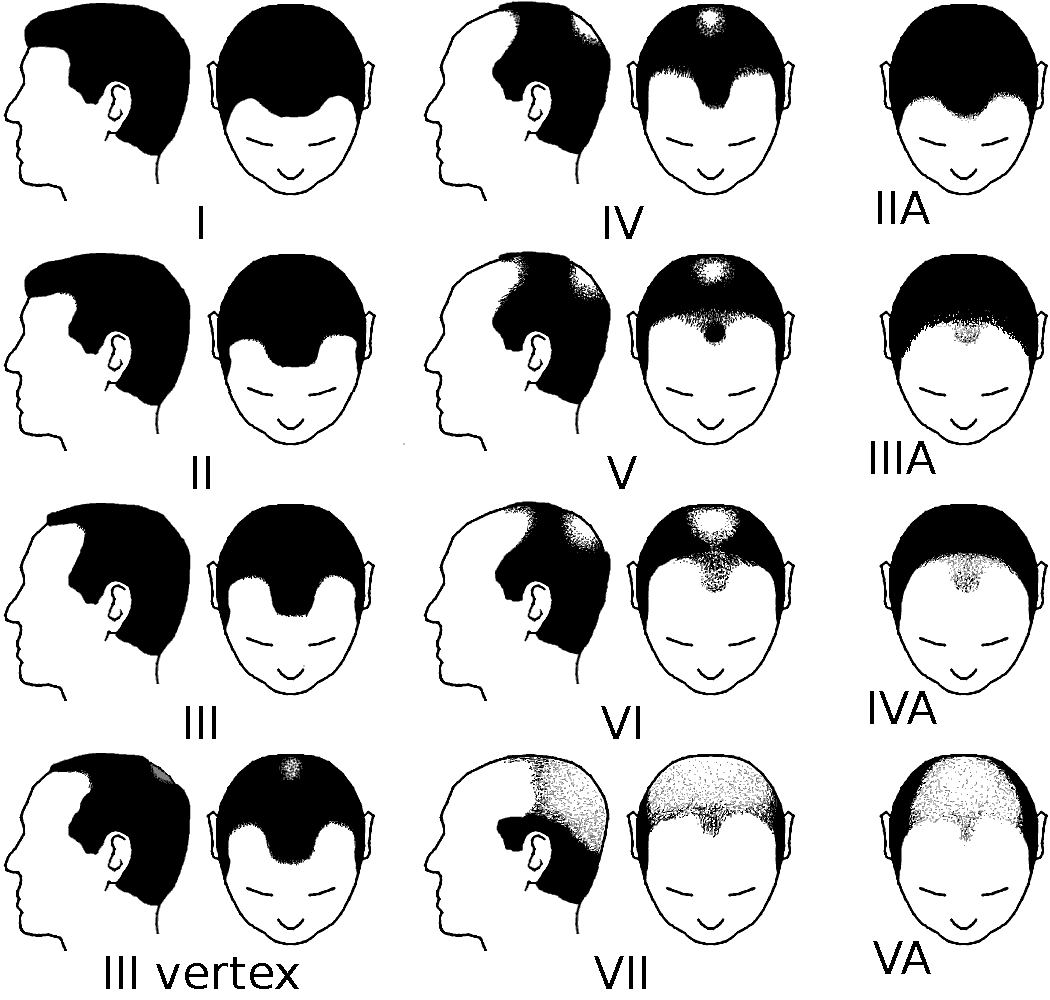 what-are-the-different-types-of-hair-loss-dr-tim-r-love